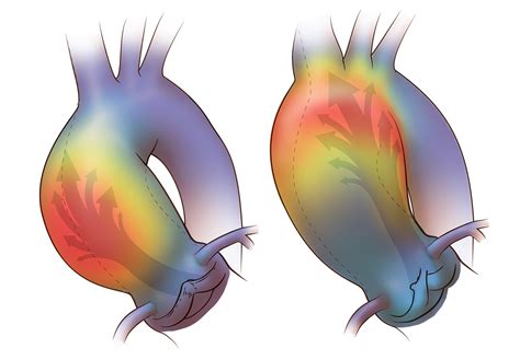 Bicuspid Aortic Valve and aortic aneurysm on Behance