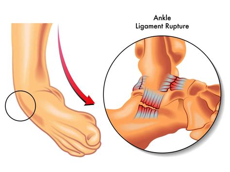 [논문리뷰] 발목 염좌 외측인대 손상 재활 방법 (Lateral Ankle Sprain / ATFL, CFL, PTFL ...