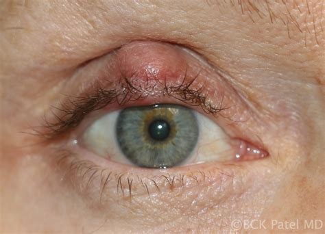 Moran CORE | What are the differences between a stye, a chalazion, an internal hordeolum and an ...