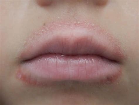 Perioral dermatitis: causes, symptoms, diagnosis, treatment, diet | Health 2024