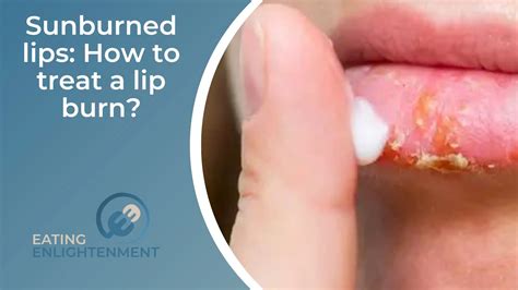 Sunburn on lips: How to treat a lip burn? — Eating Enlightenment