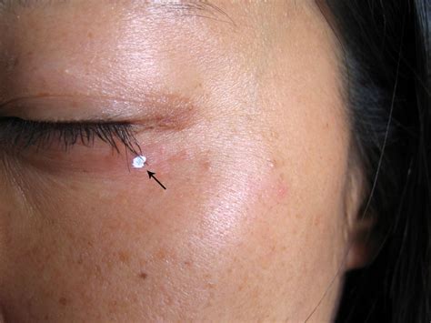 Syringoma Removal Before & After - Wart & Mole Vanish | Wart, Mole, Skin Tag & Syringoma Remover