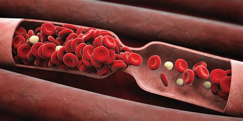 Trombosis : Sintomas Causas Y Tratamiento De La Trombosis Youtube - Read about dvt (deep vein ...