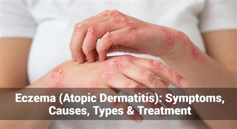 Eczema (Atopic Dermatitis): Symptoms, Causes, Types & Treatment ...