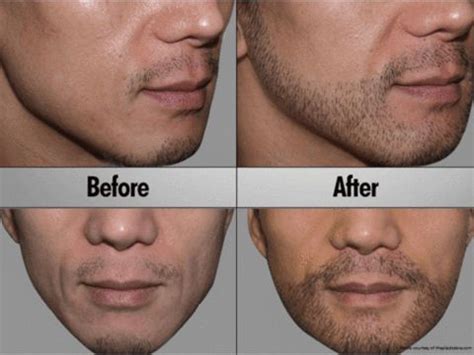 Chest Hair Transplant Before And After | Before And After
