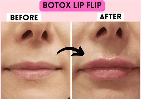 Botox Lip Flip Side Effects - the daily glimmer