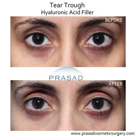 Under Eye Filler Before and After Photos - Prasad Cosmetic Surgery NY