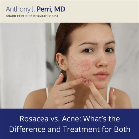 Rosacea Acne