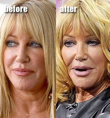 Celebrity Boob Jobs: Suzanne Somers Plastic Surgery Before and After Facelift, Browlift and ...