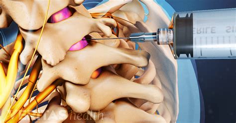 Epidural Injection Procedure