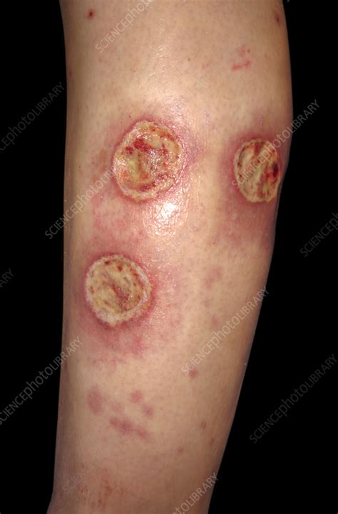 Ecthyma gangrenosum on a woman's leg - Stock Image - C058/5968 - Science Photo Library