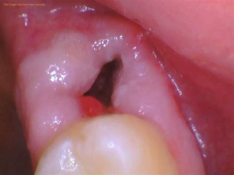 Why Is My Wisdom Tooth Hole Black? - 1311 Jackson Ave Dental | Dentist ...