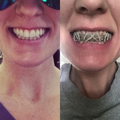 Both pics taken this morning...before and after my braces were removed after 5 years and jaw ...