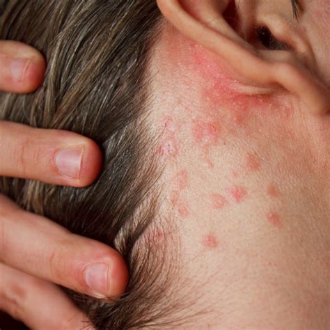Common causes of skin allergies in Florida - Skin Center of South Miami