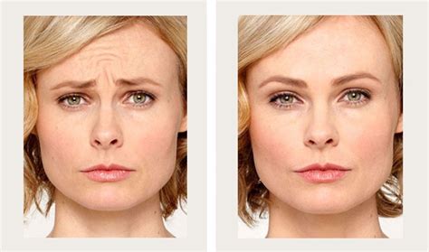 Botox Before and After (2) - Buena Vista Aesthetics | Revive Your Beauty