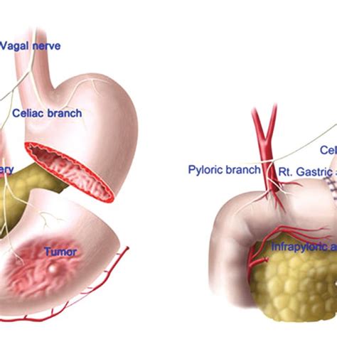 Surgical procedure of pylorus-preserving gastrectomy (PPG) 11)... | Download Scientific Diagram