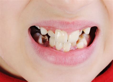 Teeth Stains: Causes, Types, and Removal - AlQudrahMC