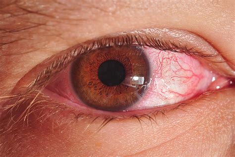 Eye pain - red flag symptoms | GPonline