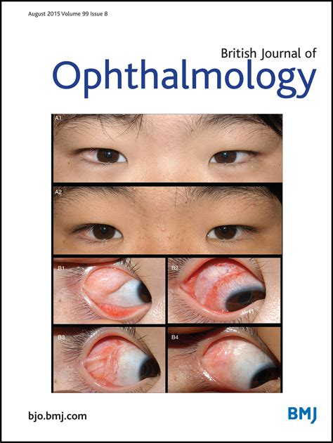 The scotogenic contact lens: a novel device for treating binocular diplopia | British Journal of ...