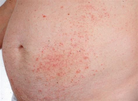 Dermatitis Herpetiformis Diagnosis With Skin Biopsy