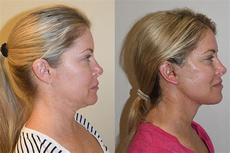 Facelift Recovery Guide - Abstra Kraft