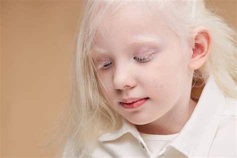 Albinism Syndrome Stock Photos - Free & Royalty-Free Stock Photos from Dreamstime