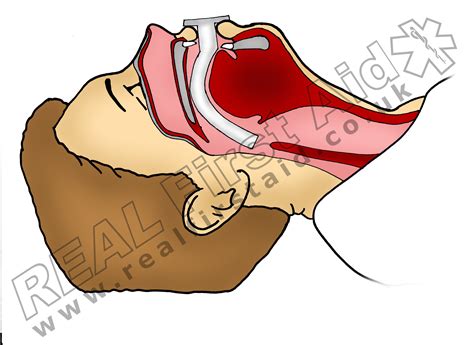 Understanding Basic Airways — REAL First Aid