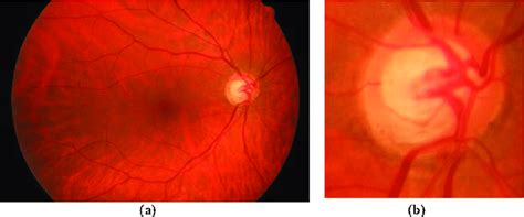 a) Glaucoma affected fundus image; (b) its ROI consists of optic disk. | Download Scientific Diagram