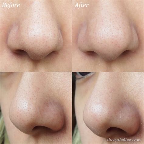 Collection 101+ Pictures Pore Strips Before And After Pictures Completed