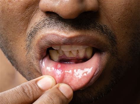 Mouth Sores: Pictures, Causes, Types, Symptoms, and Treatments