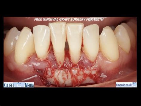 Free Gingival Graft Surgery • Video • MEDtube.net