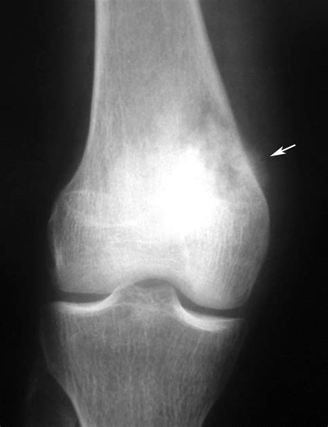 Radiodiagnosis - Imaging is Amazing-Interesting cases: Osteosarcoma of ...