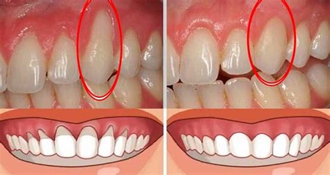 Receding Gums Front Teeth