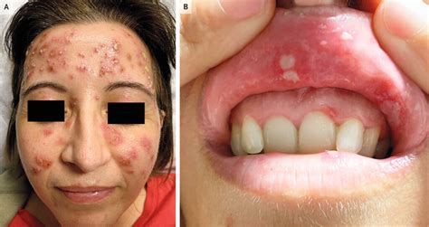 Behçet’s Disease with Papulopustular Rash