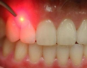 Is Laser Gum Treatment Right for You? | Winterholler Dentistry & Implant Surgery