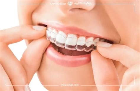 Removable Braces: Pros, Cons, and Cost | ILAJAK Medical