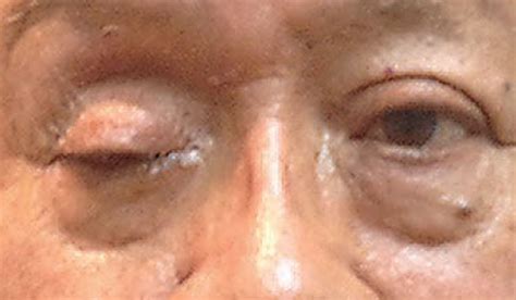 OD's Guide to Ptosis Workup | Presstorms