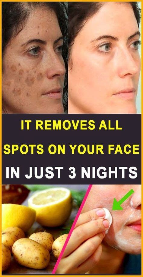 30 Natural Home Remedies To Remove Acne Scars Overnight - Fashion Blog ...