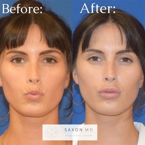 Before and after of lip filler Notice how the filler only injected into the lips also acts to ...