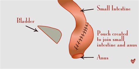 Pouchitis | Australia| PDF | PPT| Case Reports | Symptoms | Treatment