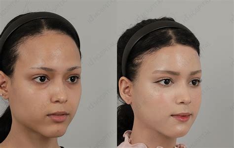 Before and After Photos / Plastic Surgery Review 【ID Hospital ...