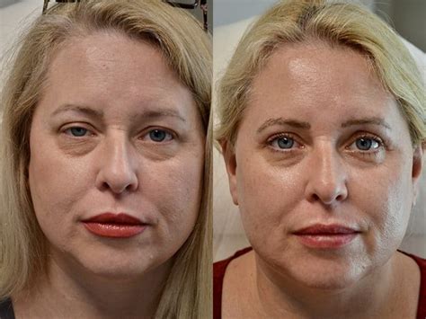 Ptosis Repair Surgery Before and After Photos - Fresh Face + Eye