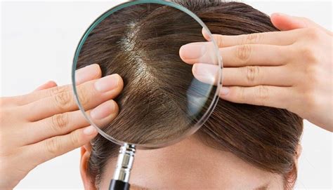 9 Cara Menghilangkan Kutu Rambut Dengan Cepat Dan Mudah - Wajib di Bacain