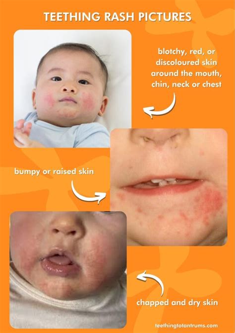 Baby Has Rash On Lips | Lipstutorial.org