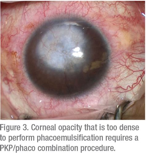 Corneal Clouding