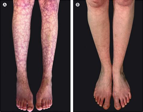 Livedo reticularis - The Lancet Rheumatology