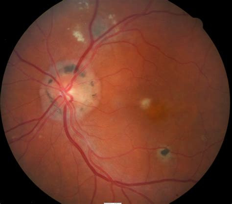 H33.011-013 Retinal Detachment with Retinal Defect - Decision-Maker PLUS