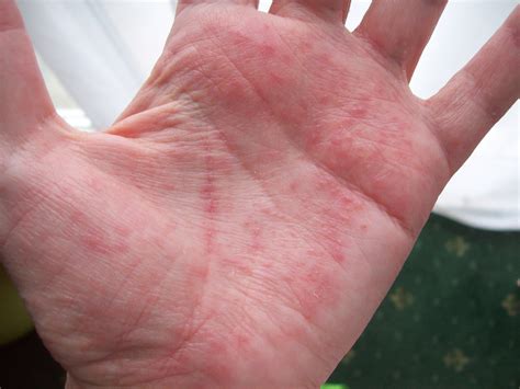 Blisters On Hands Treatment Pictures Causes Remedies - vrogue.co