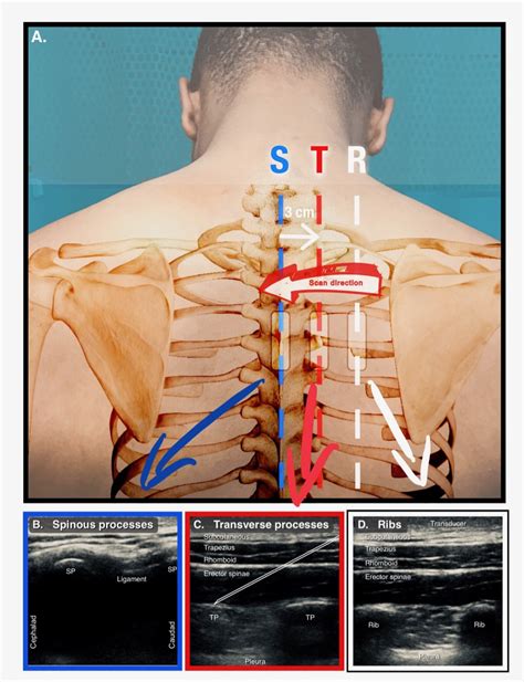 ERECTOR — Highland EM Ultrasound Fueled pain management