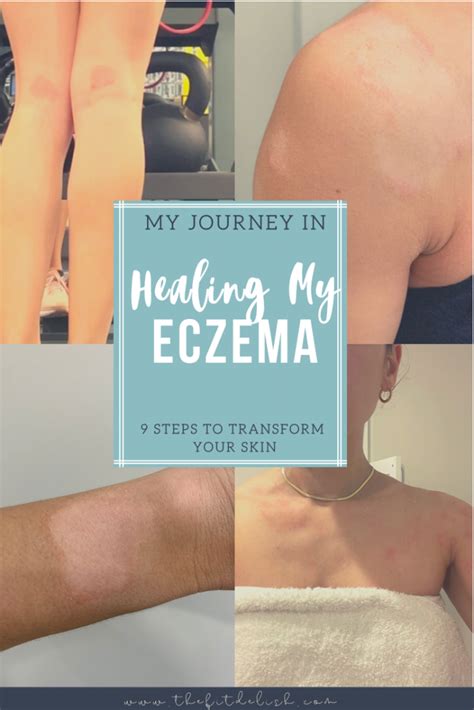 9 Steps to Healing Eczema - How I Transformed my Skin